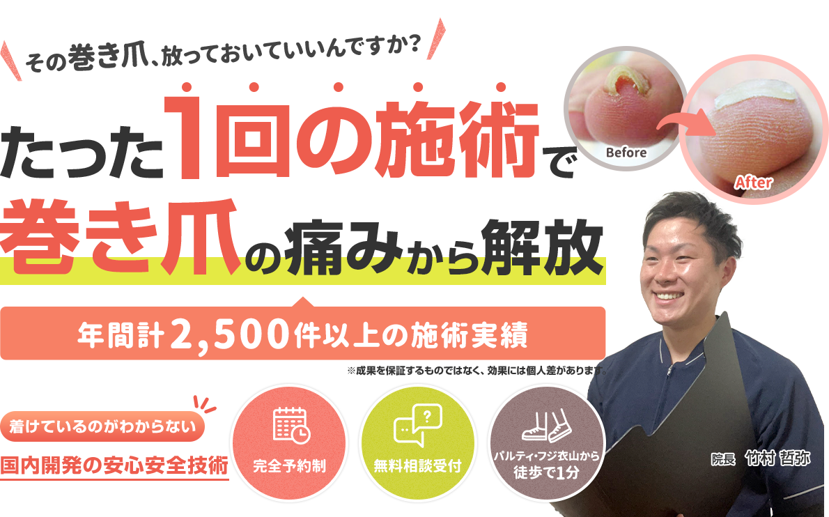 たった1回の施術で巻き爪の痛みから解放