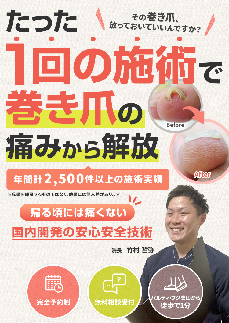 たった1回の施術で巻き爪の痛みから解放